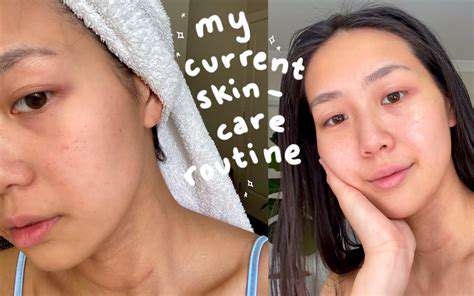 How to Treat Blackheads and Whiteheads